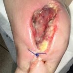 Infección después de Amputación en Paciente con Úlcera de Pie Diabético