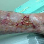 Curación Avanzada en Úlcera Venosa 2017
