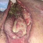 Gestión del cuidado integral de herida infectada: Fascitis Necrotizante