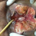 Infección de sitio operatorio en herida vulvar secundaria a carcinoma: Un desafío para la curación avanzada.