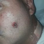 Efectos de la Curación Avanzada en Herida Facial por Proyectil de Arma de Fuego: Un caso clínico en Buenos Aires Argentina
