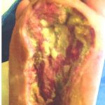 Rescate del Pie Diabético y curación avanzada de heridas: la experiencia del Hospital de Santo Domingo de los Colorados Ecuador