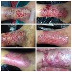 Tratamiento Avanzado de Heridas: Úlcera de Martorell