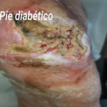 Caso clínico de pie diabético de Aracelli Orellana Canales Enfermera CESFAM La Esperanza Peumo (Chile)
