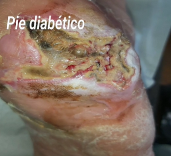 Caso clínico de pie diabético de Aracelli Orellana Canales Enfermera CESFAM La Esperanza Peumo (Chile)