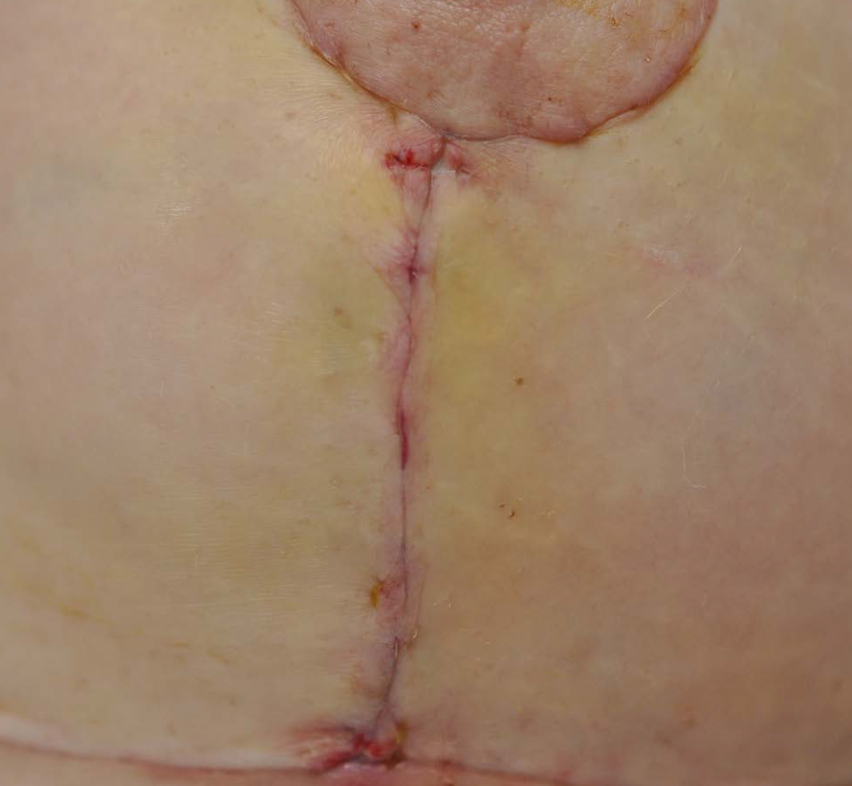 DOSSIER DE CASOS CLÍNICOS TRATAMIENTO DE CICATRICES CON ASKINA® SCAR REPAIR Y LINOVERA® SCAR REPAIR