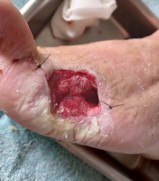 CASO AMBULATORIO PIE DIABÉTICO<br>Enfermera asesora B. Braun: Dinelly Mardones Arias